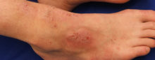 Eczema-Dry-Skin-Itch