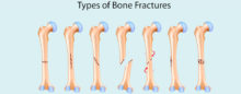 Bone-Fractures