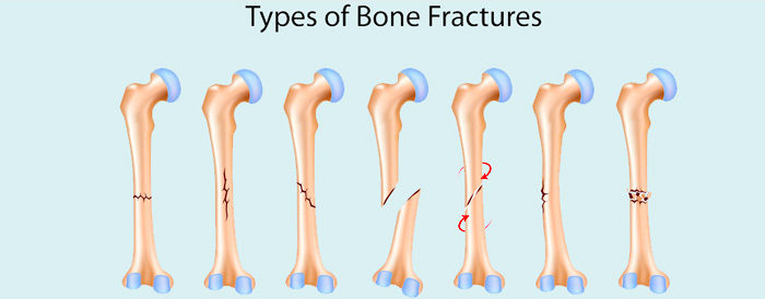 Bone-Fractures