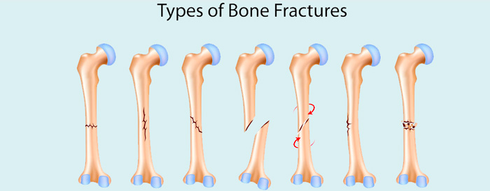 Learn About These Things That Can Damage Your Bones