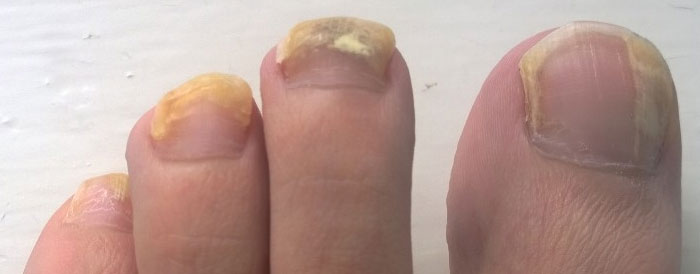 toe nail color health