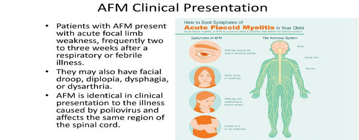 Acute flaccid myelitis